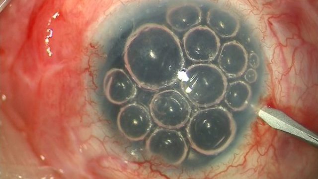 En Japón realizaron con éxito el primer trasplante quirúrgico en humanos con células de pluripotencia inducida (iPS) de un donante