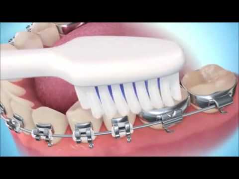 Otra alternativa que se esta utilizando como relevo de la crema dental, es el uso de lavaplatos