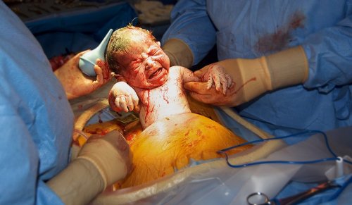 Nace por cesárea bebé prematuro que fue extraído del vientre muerto de su madre