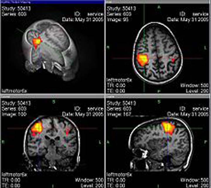 un estudio publicado  en la revista PNAS,   apoya la creencia de los historiales clínicos de los criminales y el escaneo de sus cerebros afectados por lesiones cerebrales