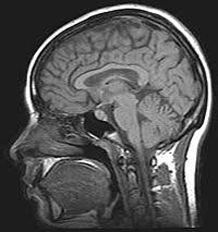 Las lesiones cerebrales pueden conllevar a cometer delitos