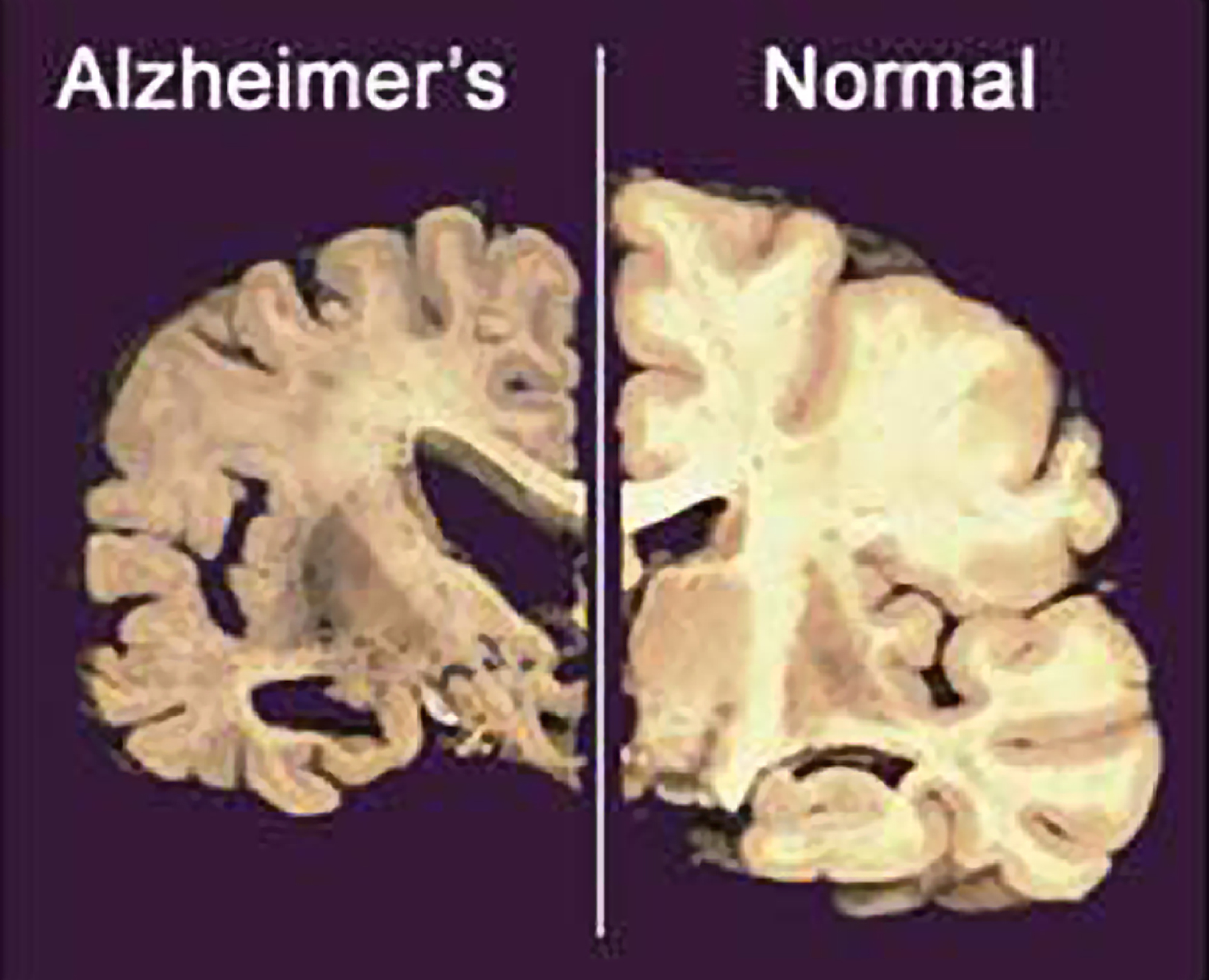 nadie sabe con certeza por qué se desarrolla la enfermedad del Alzheimer. Existen cientificos que manifiestan que la misma se asocia a la acumulación de un tipo de proteínas en el cerebro; llamadas beta amiloide y tau
