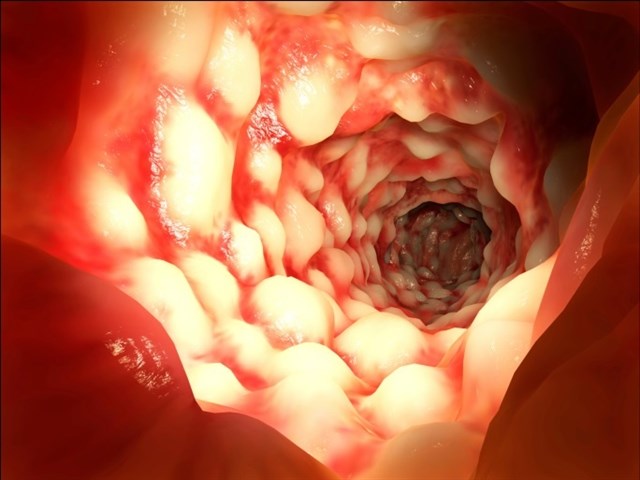 El síndrome de Lynch es la principal causa del cáncer de colon hereditario.