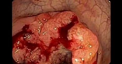 El síndrome de Lynch esta asociado a varios tipos de cáncer hereditarios