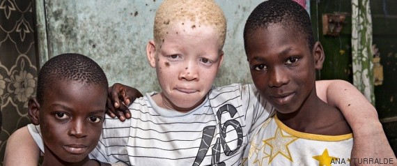 Raptan y matan a niño albino en Mozambique